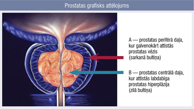 Prostatas Vēzis Latvijā: Urologs Brīdina par Kritiskas Situācijas Risku un Finansējuma Trūkumu